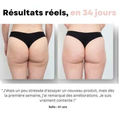 Softlift™ - Le secret d'une peau ferme, lisse et sans cellulite